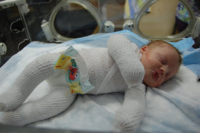 medical mom | Epidermolysis Bullosa News | Baby Jonah sleeps in the NICU with his entire body wrapped in white bandages and gauze.