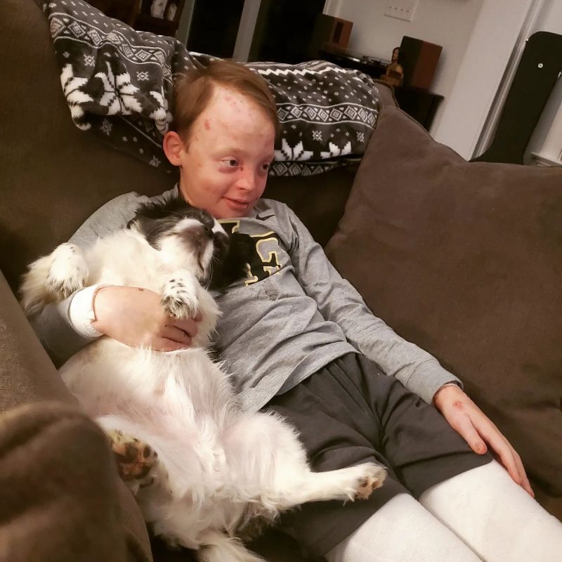 What is epidermolysis bullosa | Epidermolysis Bullosa News | Jonah watches TV while lying on the couch with his dog, Joey.