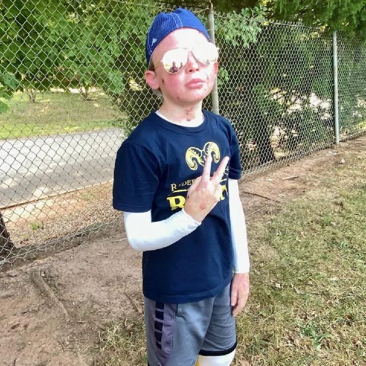 What is epidermolysis bullosa | Epidermolysis Bullosa News | Jonah poses with a backward cap and sunglasses, flashing the peace sign.