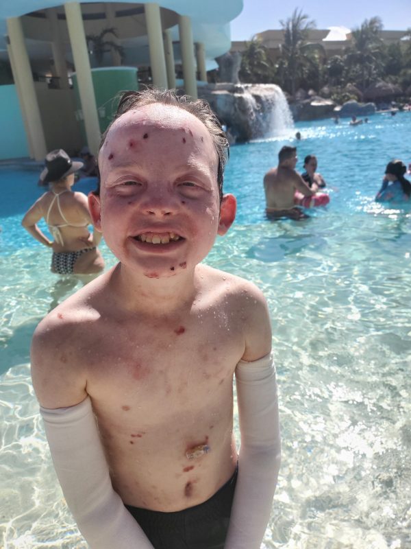good times with EB | Epidermolysis Bullosa News | Jonah stands in the shallow end of a pool at a resort in Mexico. He's wearing bandages on both of his arms, and several blisters are visible on his face, chest, and abdomen. His G-tube is also visible just above his belly button.