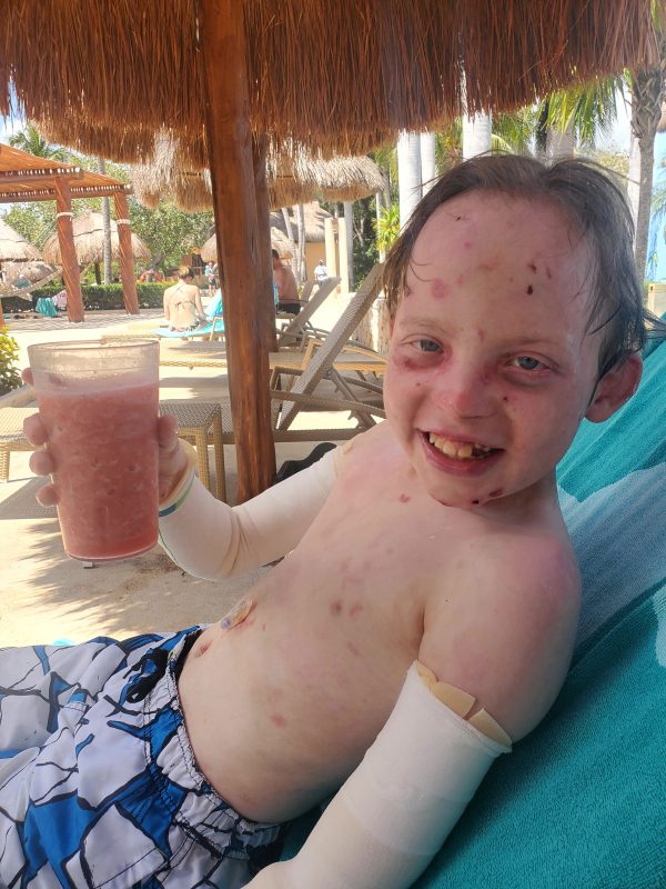 good times with EB | Epidermolysis Bullosa News | Jonah reclines on a lounge chair under an umbrella at a resort in Mexico. He is smiling and holding a virgin strawberry daiquiri.