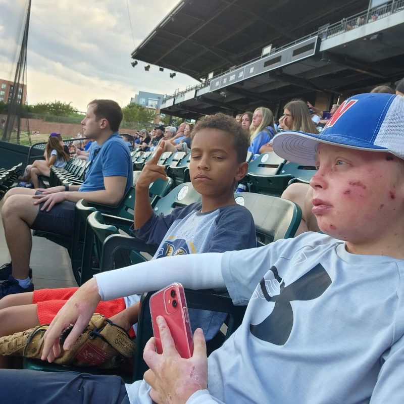 symptoms of epidermolysis bullosa | Epidermolysis Bullosa News | Jonah and Gideon sit in a stadium watching a Winston-Salem Dash minor league baseball game.