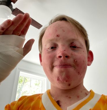 moments of joy | Epidermolysis Bullosa News | Jonah waves to the camera with his bandaged right hand after suffering immense pain following a fall 