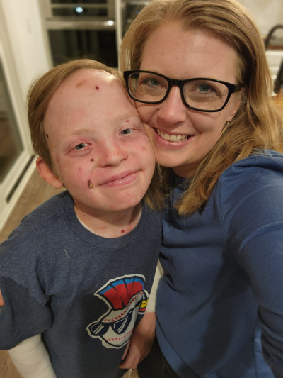 living with epidermolysis bullosa | Epidermolysis Bullosa News | photo of the face and torso of Jonah and Patrice, cheek to cheek. Both are in blue shirts, though Jonah's has a baseball logo on his.
