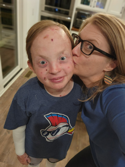 living with epidermolysis bullosa | Epidermolysis Bullosa News | photo of Jonah getting a kiss of the cheek from his mom. Both are wearing blue shirts. Jonah's arm is bandaged.