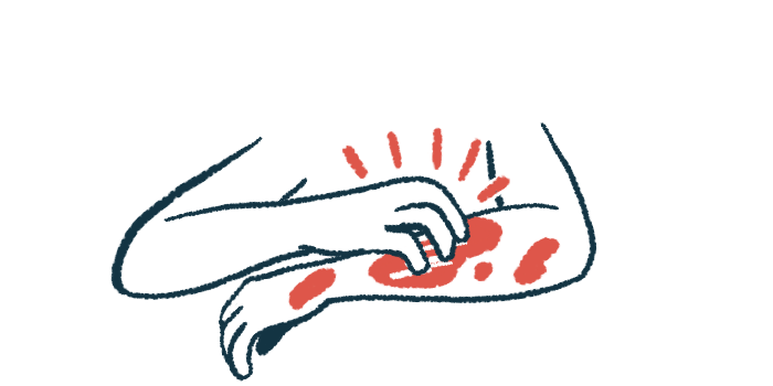 In this close-up illustration, a person uses the right hand to scratch a rash on the left forearm.