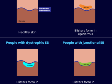 An infographic provides an overview of epidermolysis bullosa.